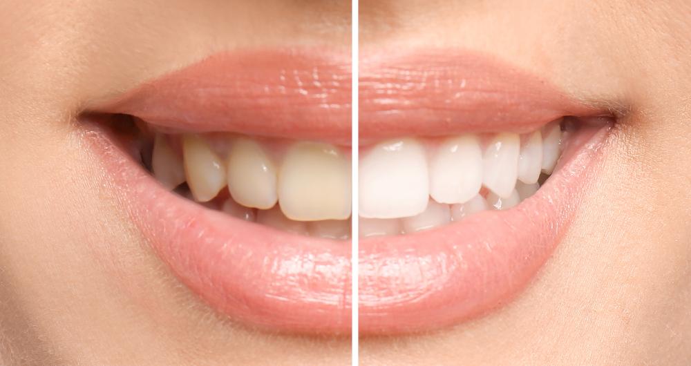 Patient's teeth before and after whitening in Neutral Bay, NSW