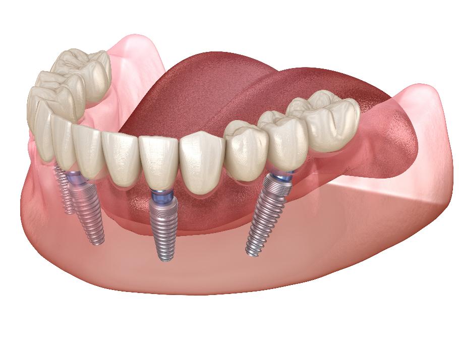 Illustration of Dental Implants in Neutral Bay, NSW