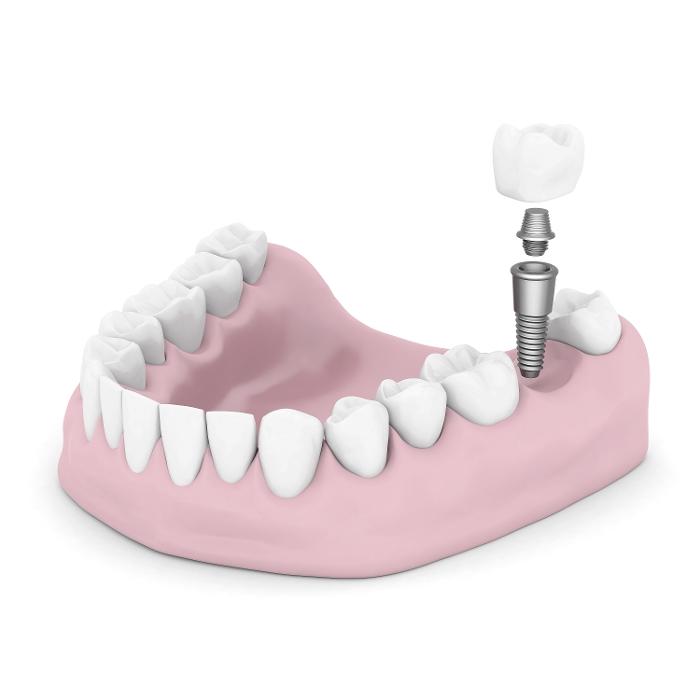 An illustration of a dental implant in Neutral Bay, NSW