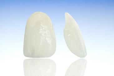 An illustration of Veneers in Neutral Bay, NSW