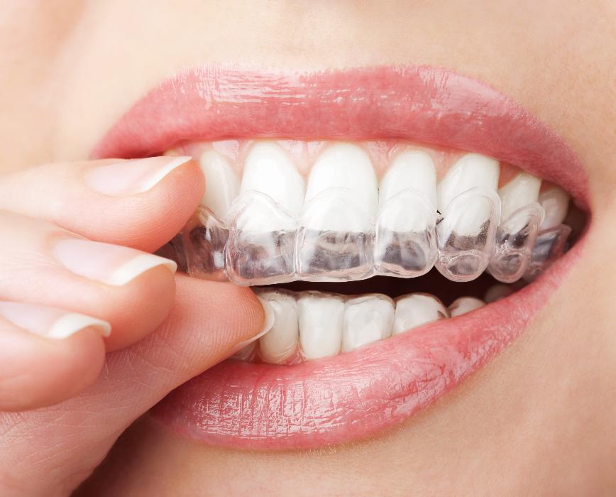 Clear aligners in Neutral Bay, NSW