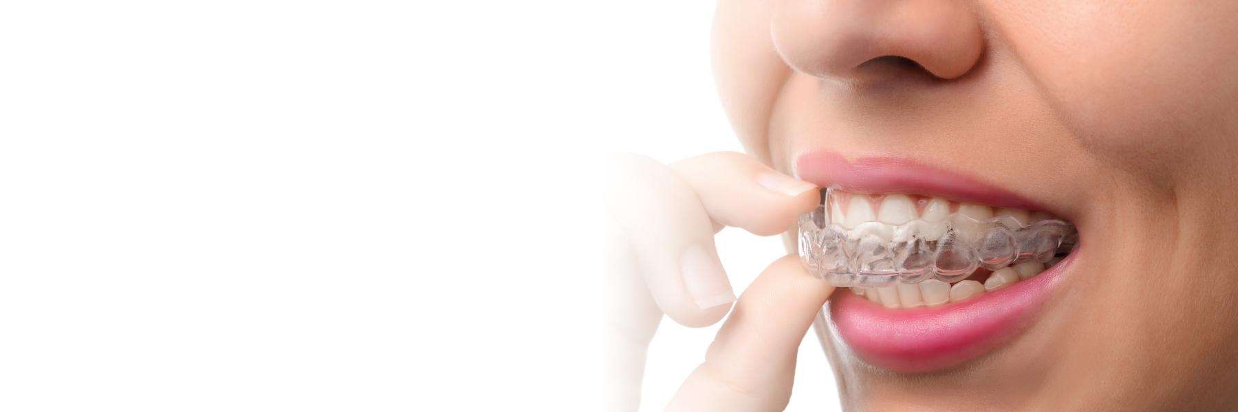 Orthodontic Care in Neutral Bay