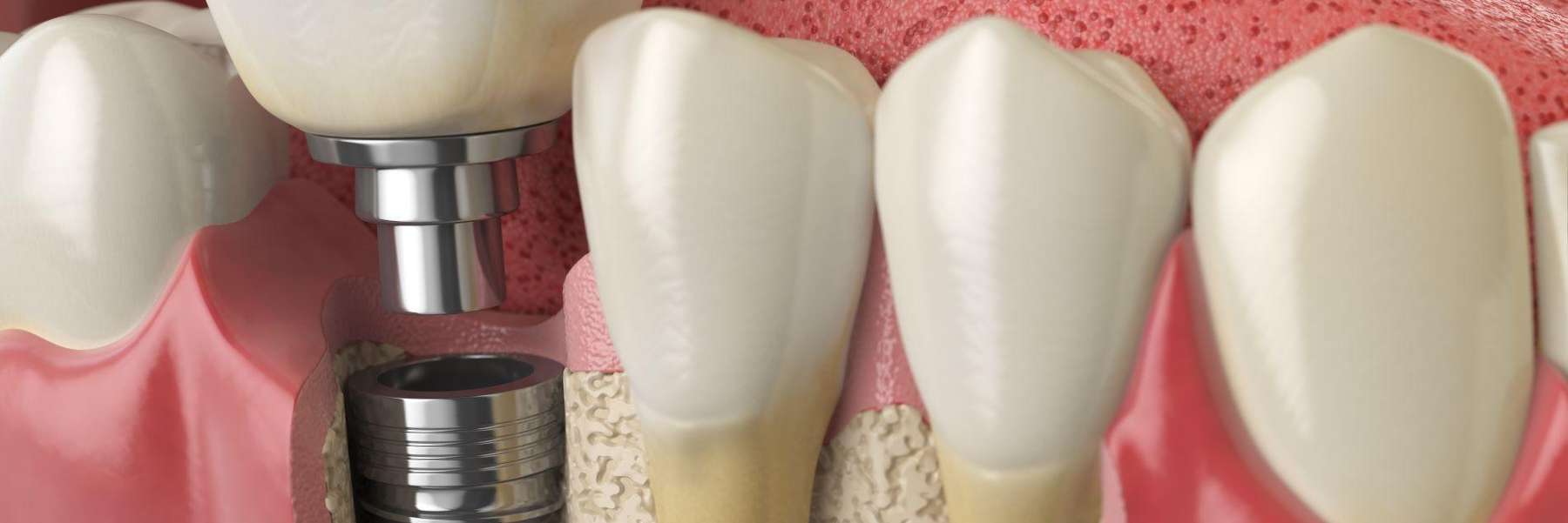 An illustration of dental implant at Sparkling Dental, Neutral bay, NSW.