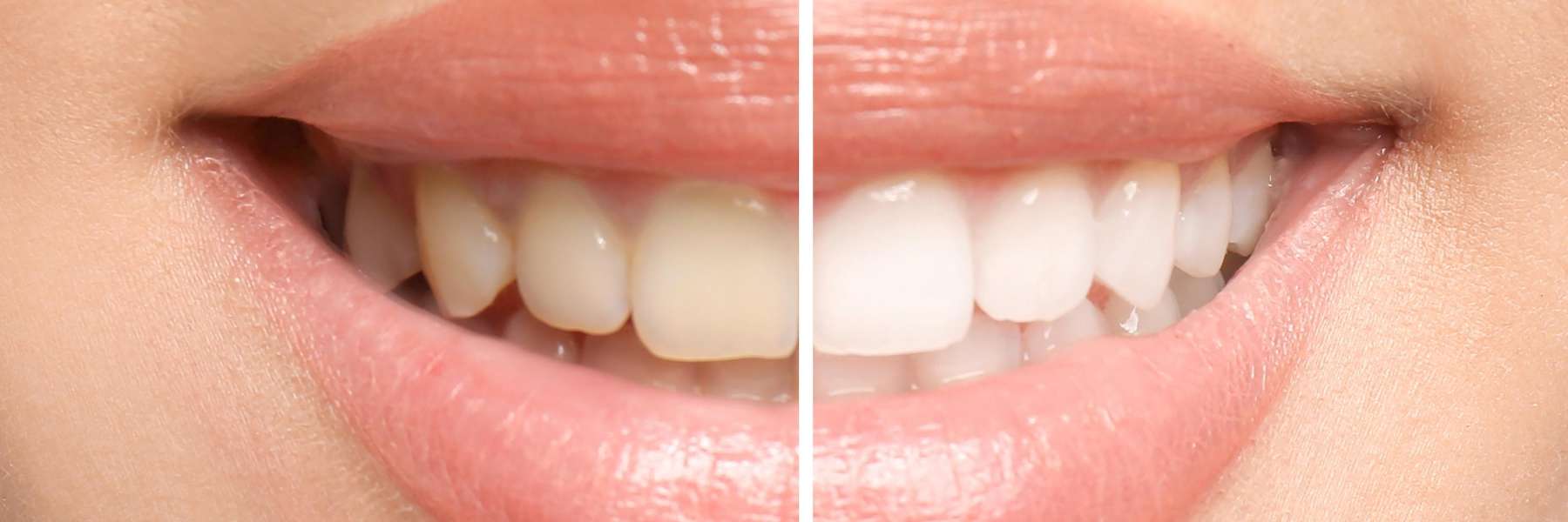 Patient's teeth before and after professional whitening at Sparkling Dental