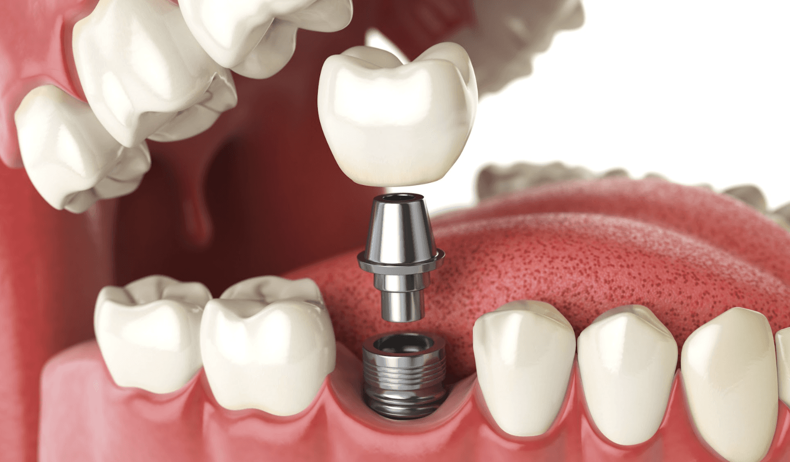 An illustration of a dental implant in Neutral Bay, NSW