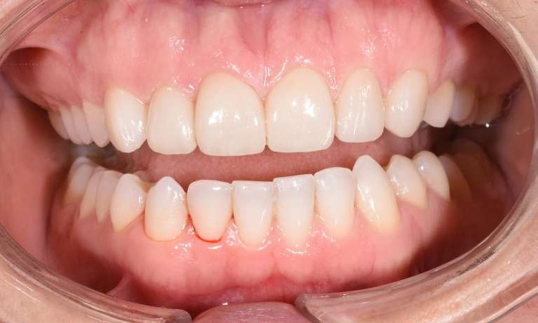 Porcelain veneers dentist neutral bay after