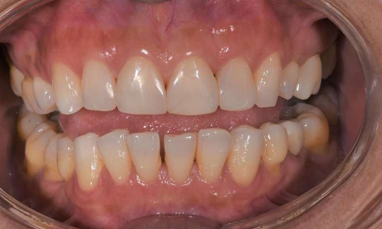 Patient's teeth after getting composite veneeers from Sparkling Dental