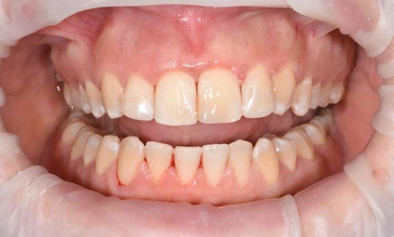 Dentist Neutral Bay broken tooth after