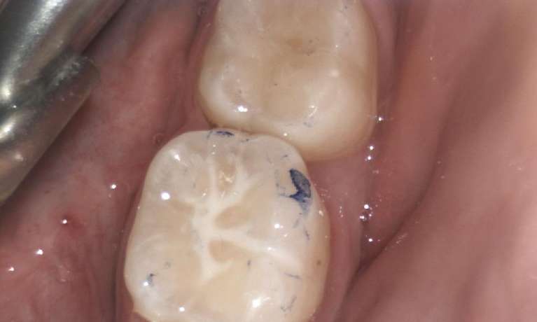 Fissure-Sealants-After-Image