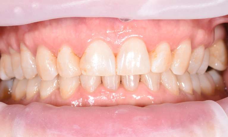 Invisible-Aligners-Straighten-Your-Teeth-After-Image