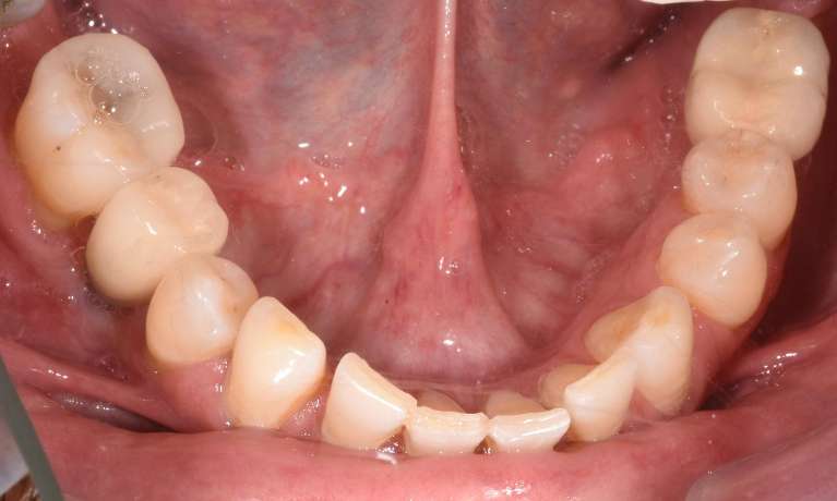 Missing-Tooth-Dental-Implants-After-Image