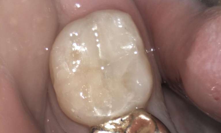 Tooth-coloured-Filling-on-a-Molar-Tooth-After-Image