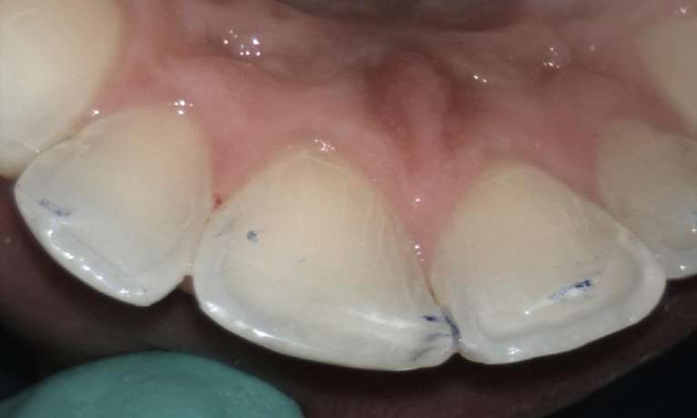 Tooth-coloured-Fillings-After-Image