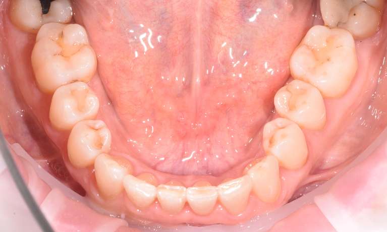 Patient's teeth after using aligners from Sparkling Dental