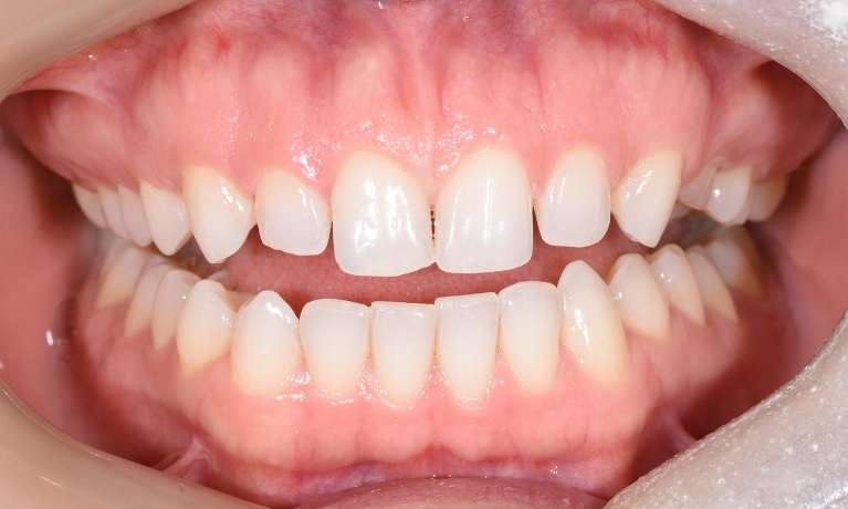 Porcelain veneers dentist neutral bay before