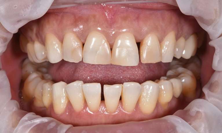 Patient's teeth before getting composite veneers