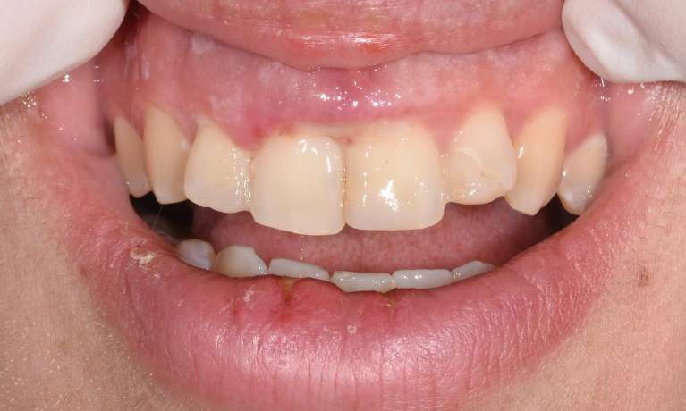 Dentist Neutral Bay Trauma broken tooth