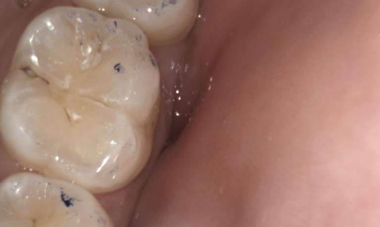 Fissure-Sealants-Before-Image