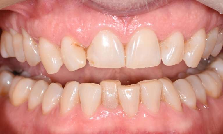 Invisible-Aligners-Straighten-Your-Teeth-Before-Image