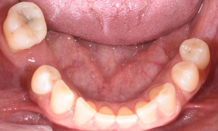 Missing-Tooth-Dental-Implants-Before-Image