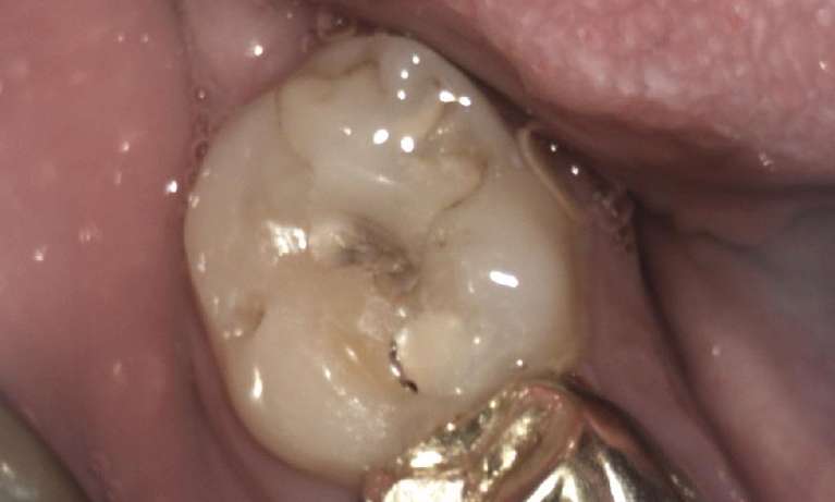Tooth-coloured-Filling-on-a-Molar-Tooth-Before-Image