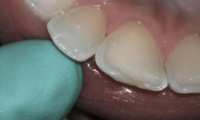 Tooth-coloured-Fillings-Before-Image