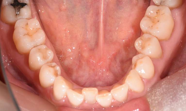 Patient's teeth before using aligners